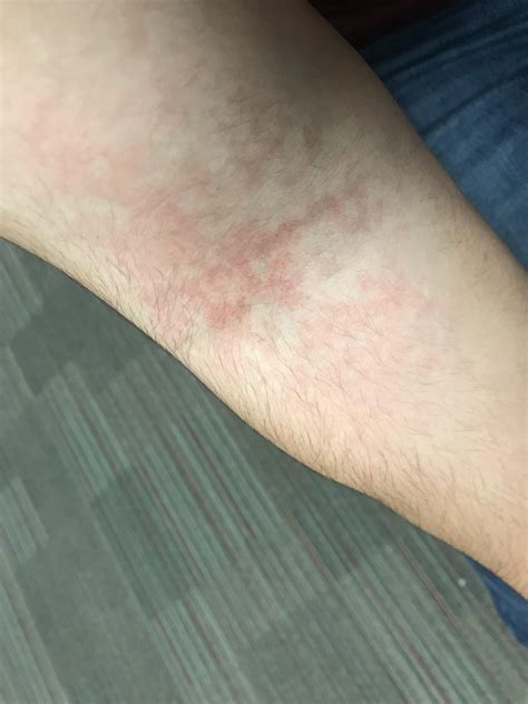 Skin Concern Any Help With How To Treat Its In Inner Elbows And