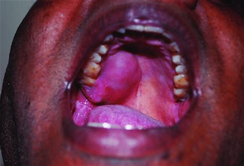 Intra Oral Picture Showing Swelling In The Right Posterior Aspect Of
