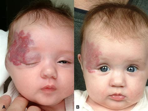 Treatment Of Periocular Infantile Hemangiomas With Propranolol Case
