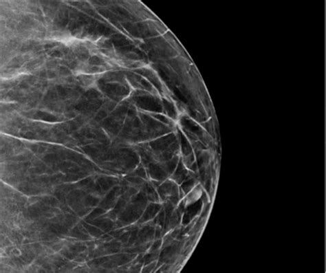 Study Ai Improves Cancer Detection Rate For Digital Mammography And