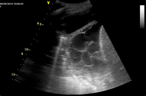 If none is present the fluid is virtually always a transudate. Pleural Effusion
