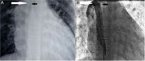 Right Paratracheal Mass On Chest X Ray An Important Part Of The