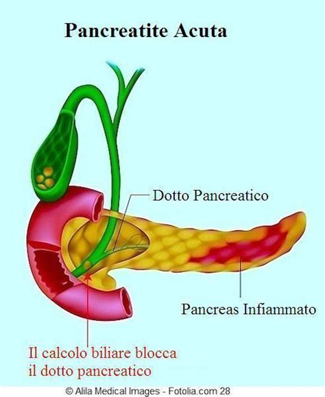 A pancreatite é uma doença caracterizada por uma inflamação do pâncreas, que ocorre quando as o número de casos de pancreatite crónica tem aumentado de modo muito significativo nos últimos. Pancreatite acuta e cronica, sintomi, cause e terapia