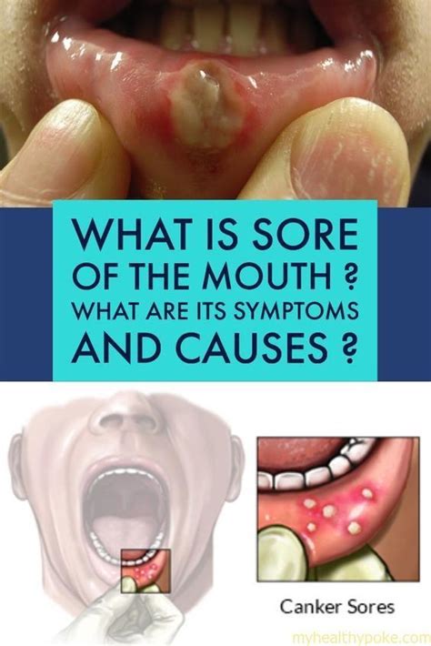 What Is Sore Of The Mouth What Are Its Symptoms And Causes Oral