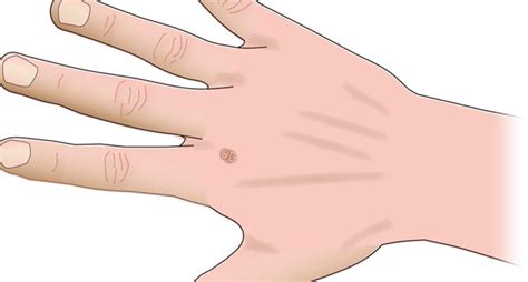 4 Common Types Of Hand Tumors The Hand Society