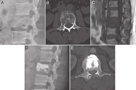 A E A Preoperative Lateral Radiograph Showing A Metastatic Spinal