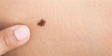 More Than 11 Moles On One Arm Could Indicate Higher Risk Of Skin Cancer Huffpost Uk
