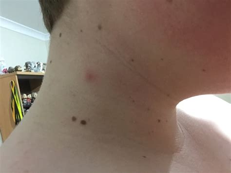 When Should I Worry About Red Spots Appearing On My Neck Human