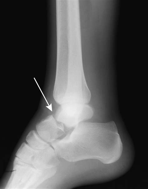 Talus Fractures Orthoinfo Aaos