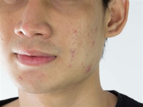 Skin Bumps That Look Like Pimples But Arent Insider