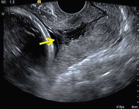 How To Measure Cervical Length Kagan 2015 Ultrasound In Obstetrics And Gynecology Wiley