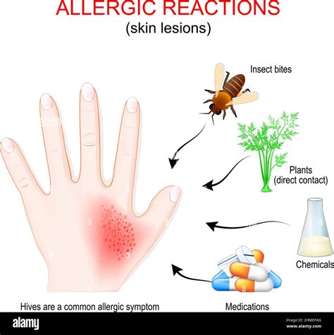 Réaction Allergique Et Lésions Cutanées La Main Humaine Avec Une