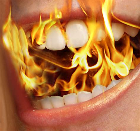 Burning Mouth Syndrome Mouth And Teeth Diseases Epharmapedia