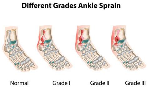 What Is A Foot Or Ankle Sprain Or Fracture South Florida Podiatry