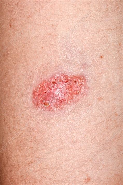 Cutaneous Leishmaniasis Lesions Stock Image C Science The Best Porn Website