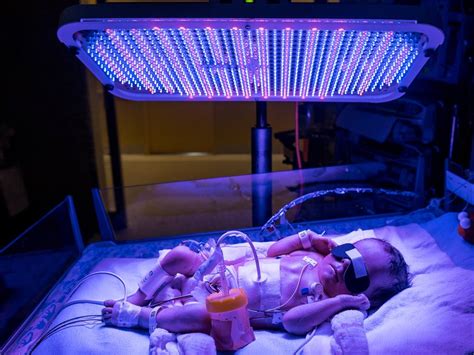 New Phototherapy Machine To Treat Jaundice In Babies Donated To