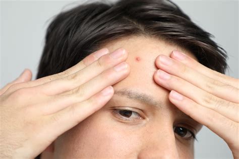 Cystic Acne Treatment Singapore Advice From A Doctors Perspective