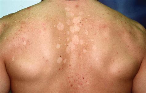 Tinea Versicolor Pictures Treatment Causes Contagious Symptoms