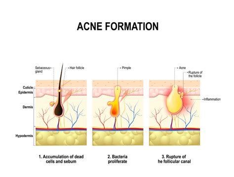 Acne Treatments In Virginia Washington Dc And Maryland