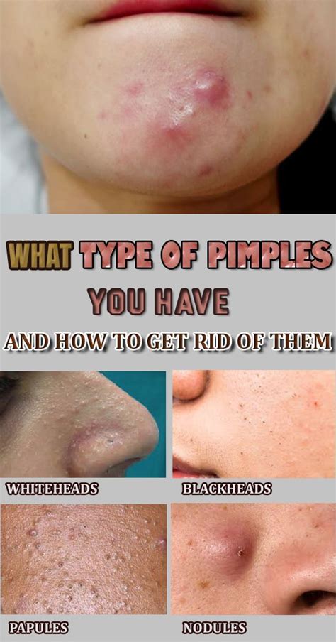 What Type Of Pimples You Have And How To Get Rid Of Them Pimples
