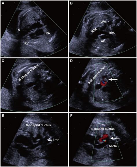 The Fetal Echocardiography Was Done At 23 Weeks Of Gestation A The