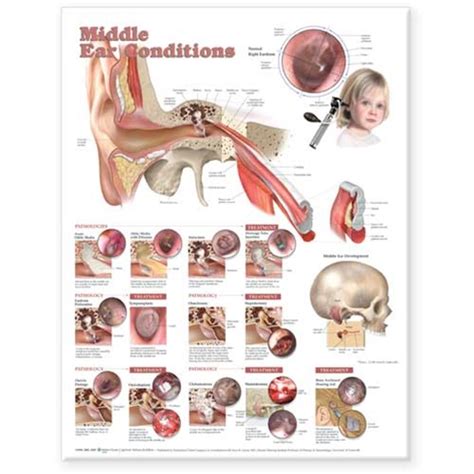Middle Ear Conditions Anatomical Chart Anatomy Models And Anatomical
