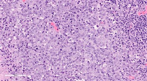 Pathology Outlines Rhabdoid Tumor