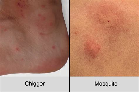 Chigger Bites Vs Mosquito Bites How To Tell The Difference The Healthy