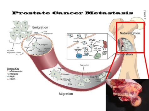 Other symptoms of recurrent cancer may depend on whether. RESEARCH -The James Buchanan Brady Urological Institute ...