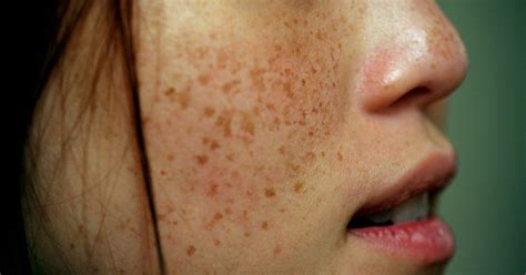 Buang Bintik Hitam Di Muka Dengan Cara Paling Berkesan - Story of