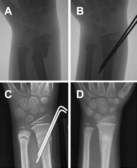Kids Wrist Fracture Raleigh Hand Surgery — Joseph J Schreiber Md