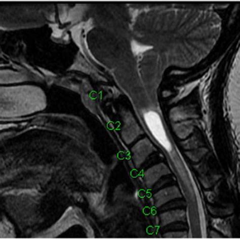 A Cervical T2 Weighted Mri Sagittal View Low Lying Cerebellar