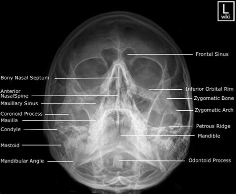 Patient prone or upright 3. Facial Bones - Occipito Mental (OM) | Radiology, Facial ...