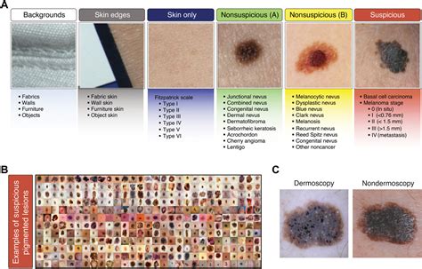 Using Deep Learning For Dermatologist Level Detection Of Suspicious