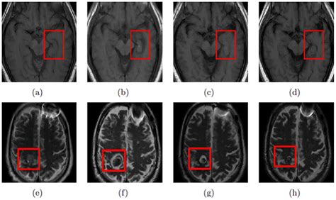 Ad Show A 2d T1w Mri Slice At Different Time Points Pre Litt A