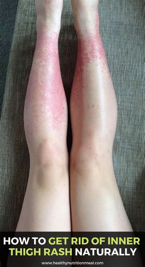 How To Get Rid Of Inner Thigh Rash Naturally With Images Inner