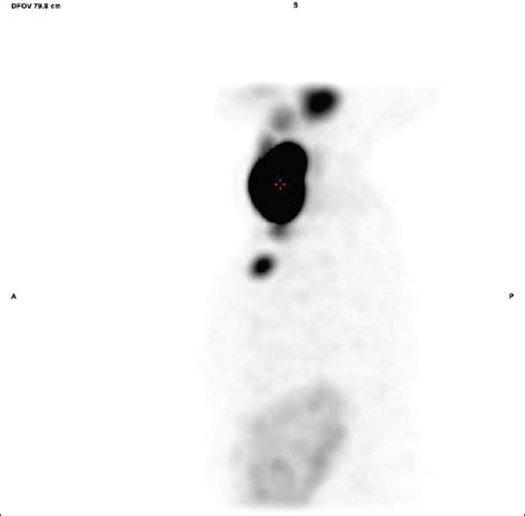 Retrosternal Ectopic Thyroid Mimicking Esophagus In Tc 99m