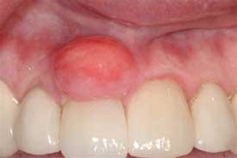 Peripheral Odontogenic Ossifying Fibroma Registered Dental Hygienists