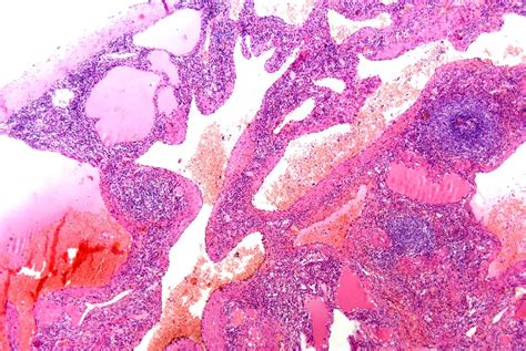 Pathology Outlines Hemangioma