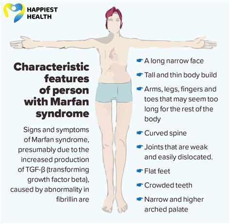 Marfan Syndrome Face