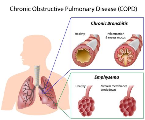 CHRONIC OBSTRUCTIVE PULMONARY DISEASE Redcare