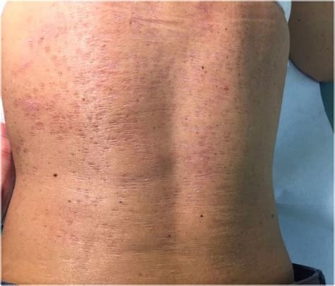 Atrophic Pityriasis Versicolor Occurring In A Patient With Sjögrens