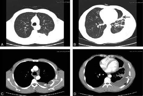 Pulmonary Paragonimiasis Mimicking Tuberculous Pleuritis A Medicine