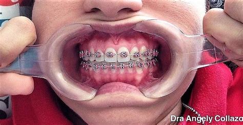 Pingl Par John Beeson Sur Orthodontic Braces Orthodontie