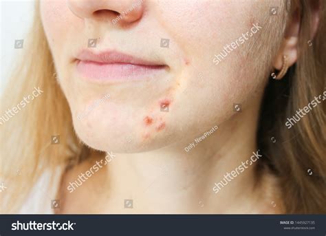 Womans Oily Skin Acne Problems Scars Stock Photo 1445927135 Shutterstock
