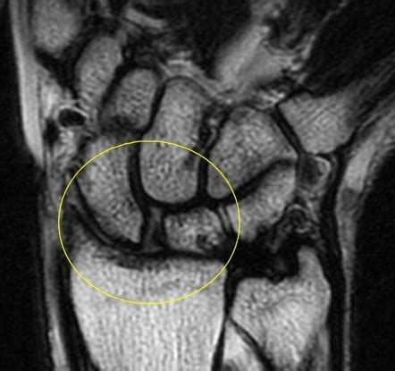 Scapholunate Ligament Tear Cortical Ring Sign Image Radiopaedia Org