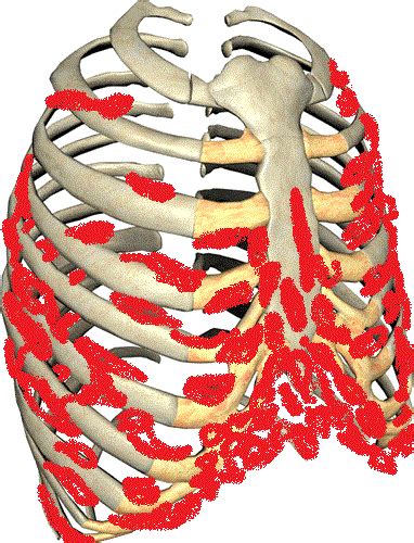 This Is A Picture Of How Dercums Disease Attaches Itself To The Rib Cage And Chest Wall Each