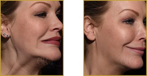 The Super Nefertiti Lift Before And After Images Dr Gerald Bock