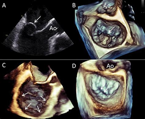 Mitral Valve Imaging With Ct Relationship With Transcatheter Mitral