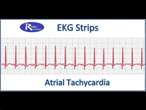 Nclex Ekg Strips Atrial Tachycardia Youtube